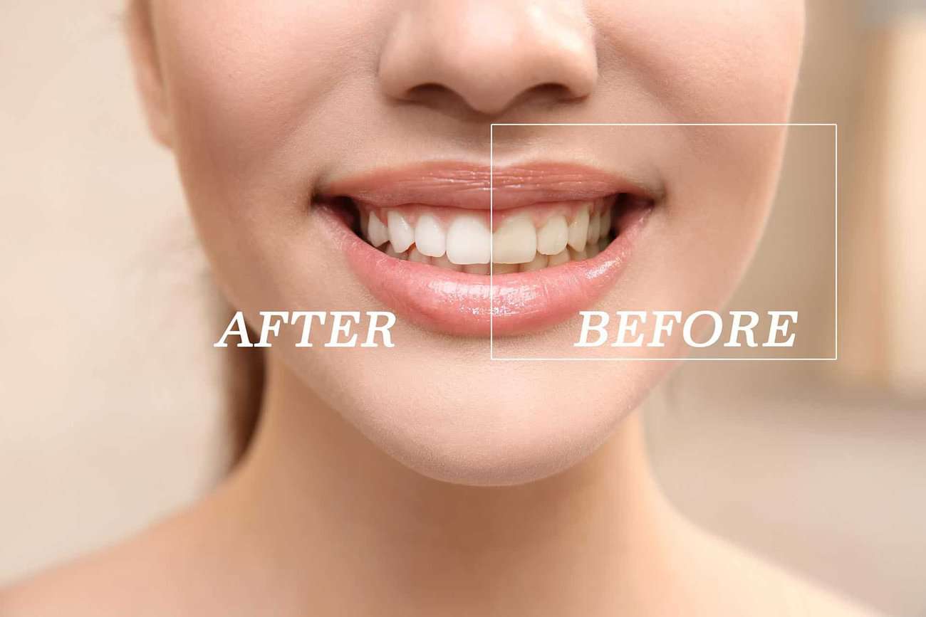 What Are the Most Effective Natural Teeth Whitening Methods You Can Try Southall?