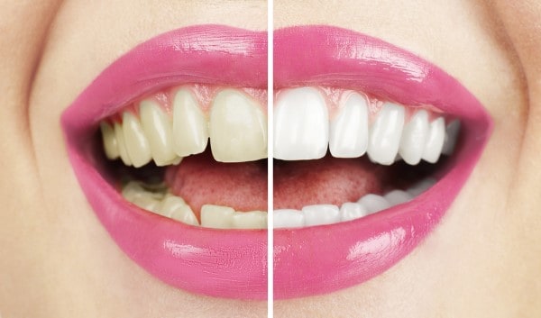 What Early Signs of Oral Cancer Should You Never Ignore Southall?