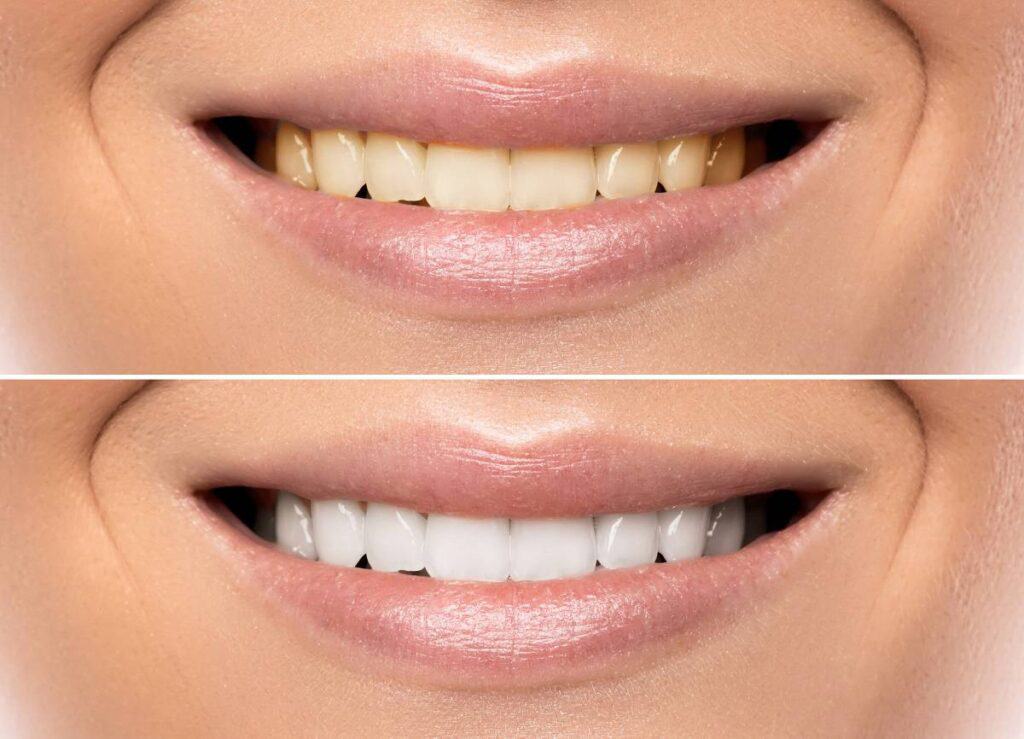 How Does Gum Disease Progress if Left Untreated Southall?