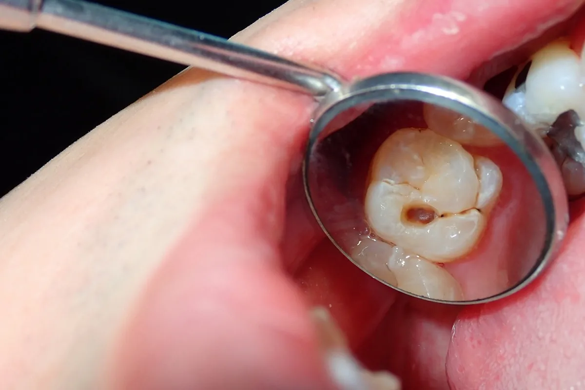 Why Do Teeth Crack? Common Causes to Know Southall