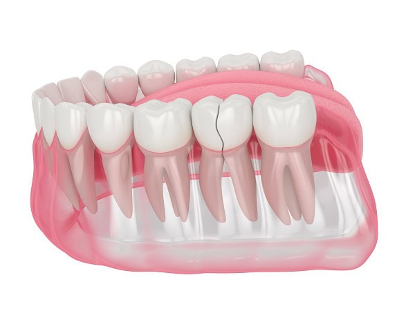 How Can You Manage Pain and Discomfort After a Root Canal Southall?