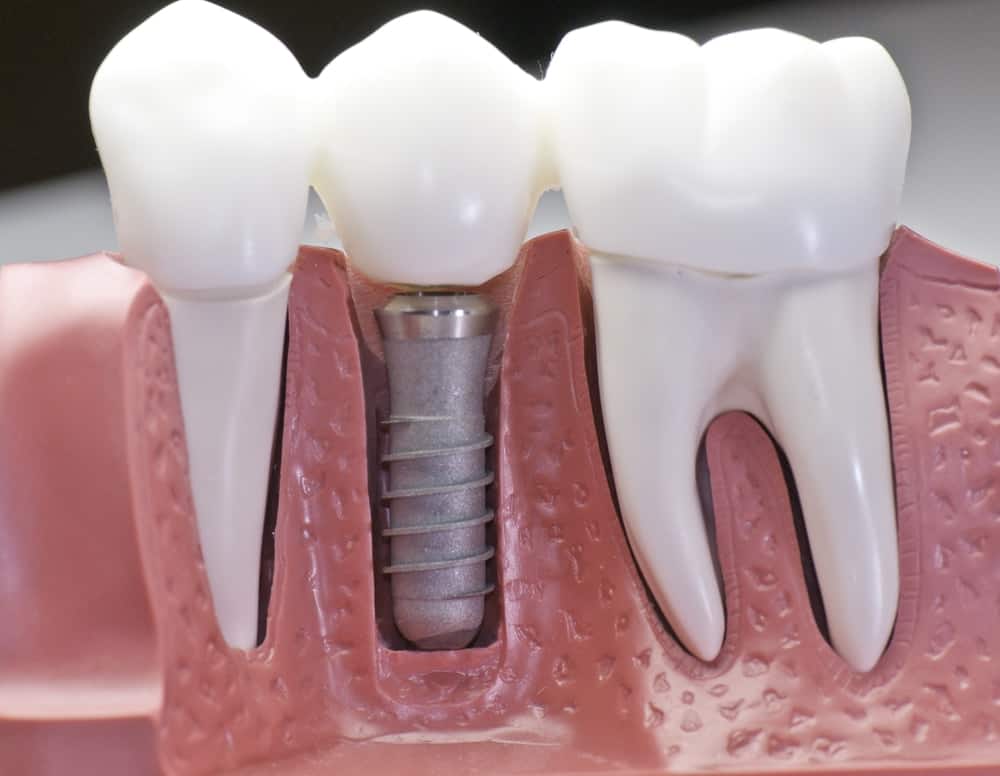 Common Misconceptions About Modern Dental Treatments Southall
