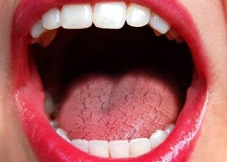 Common Causes of Dry Mouth (Xerostomia) Southall