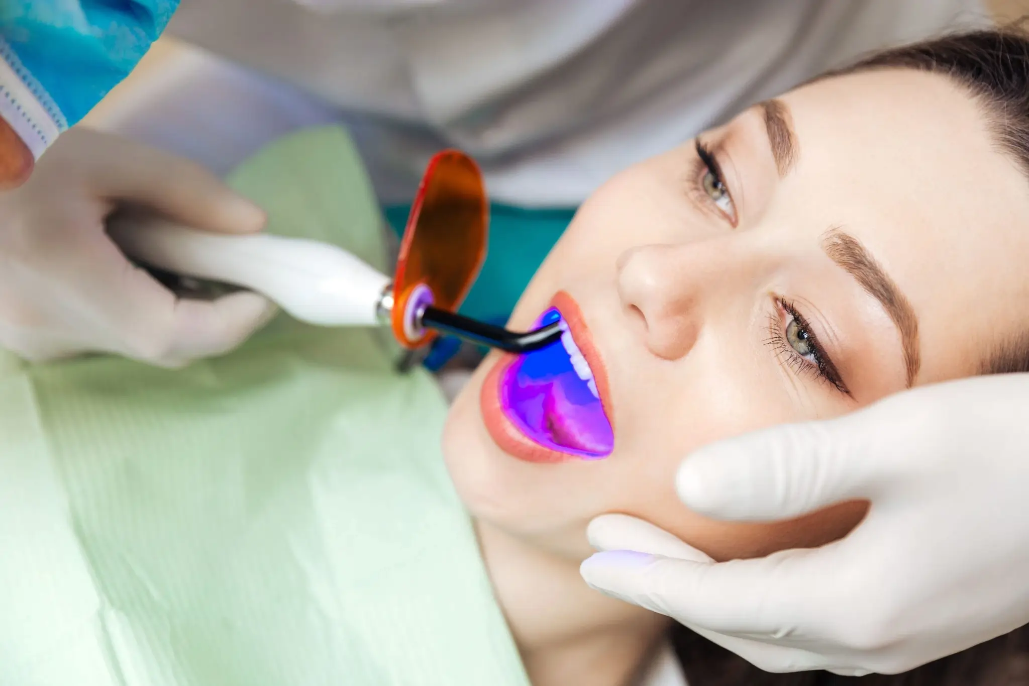 Common Risks of Whitening Without Expert Dental Guidance Southall