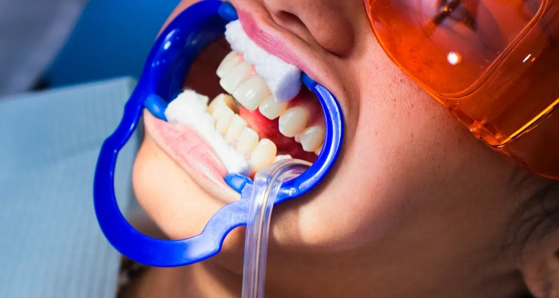 How Teeth Whitening Treatments Actually Work on Your Enamel Southall