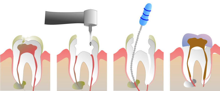 How Do You Properly Care for Your Teeth After a Root Canal Southall