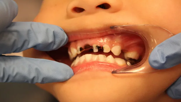 Which Foods and Drinks Cause the Most Damage to Young Smiles Southall?