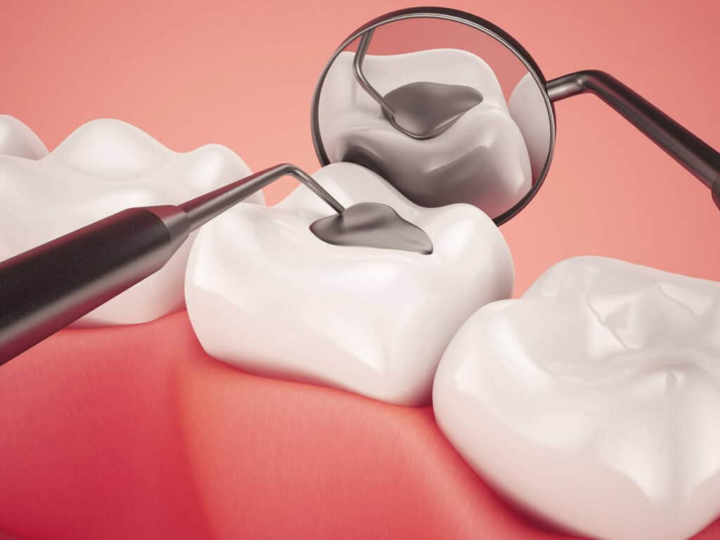 Fighting Cavities and Plaque Buildup Southall