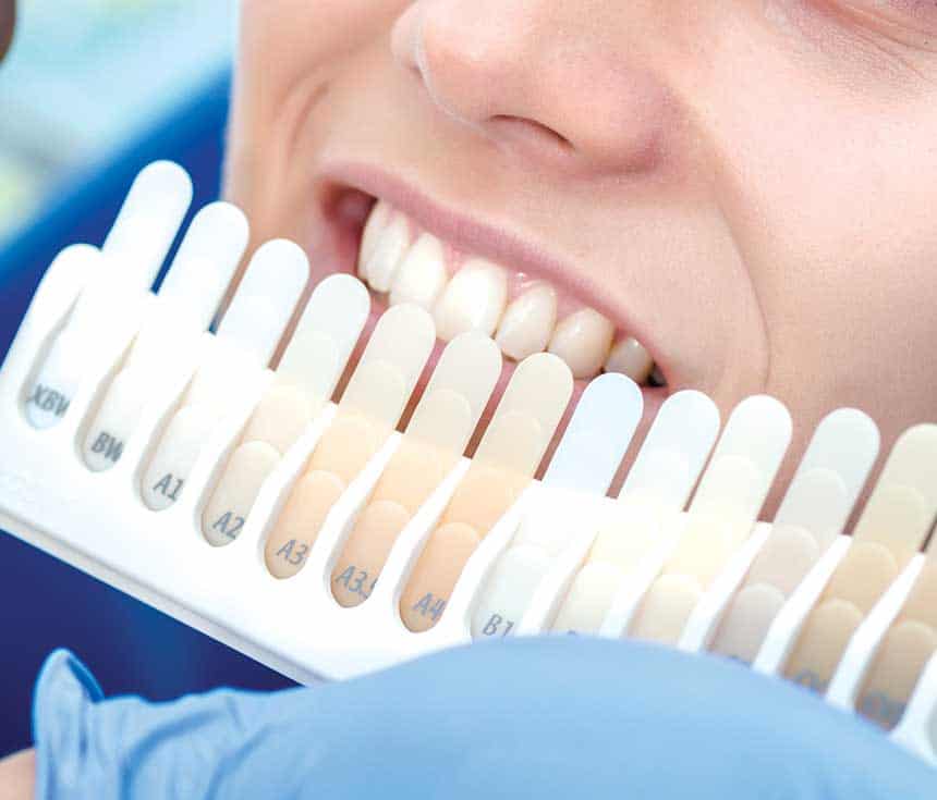 Professional vs At-Home Whitening: What You Need to Know Southall