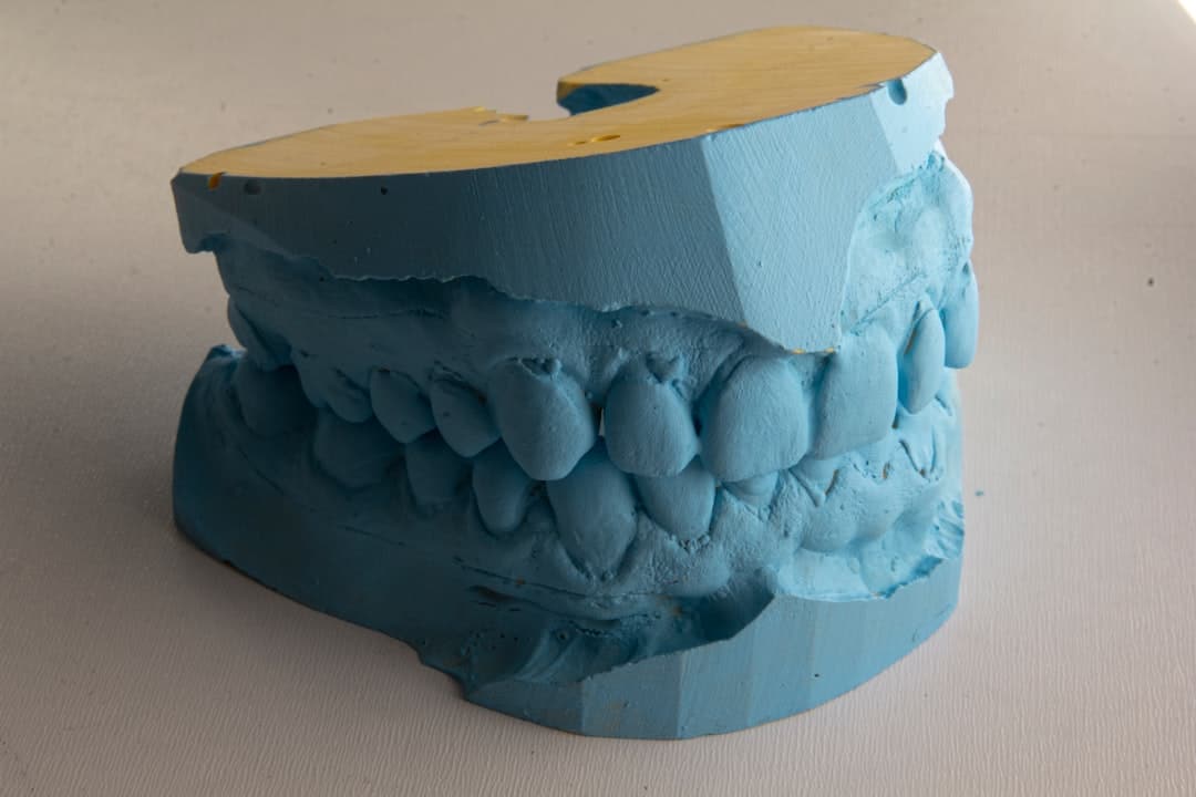 How Do Dental Implants Improve Jawbone Health and Oral Function Southall?