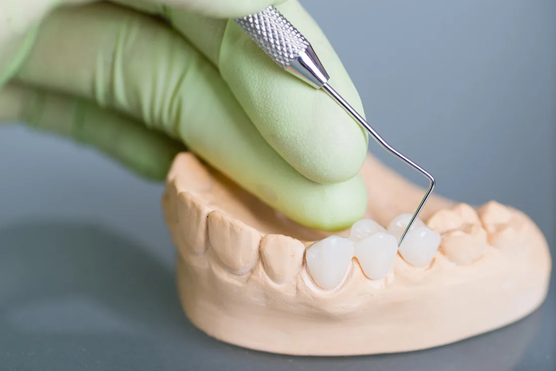 What Are the Different Types of Dental Crowns Available Southall?