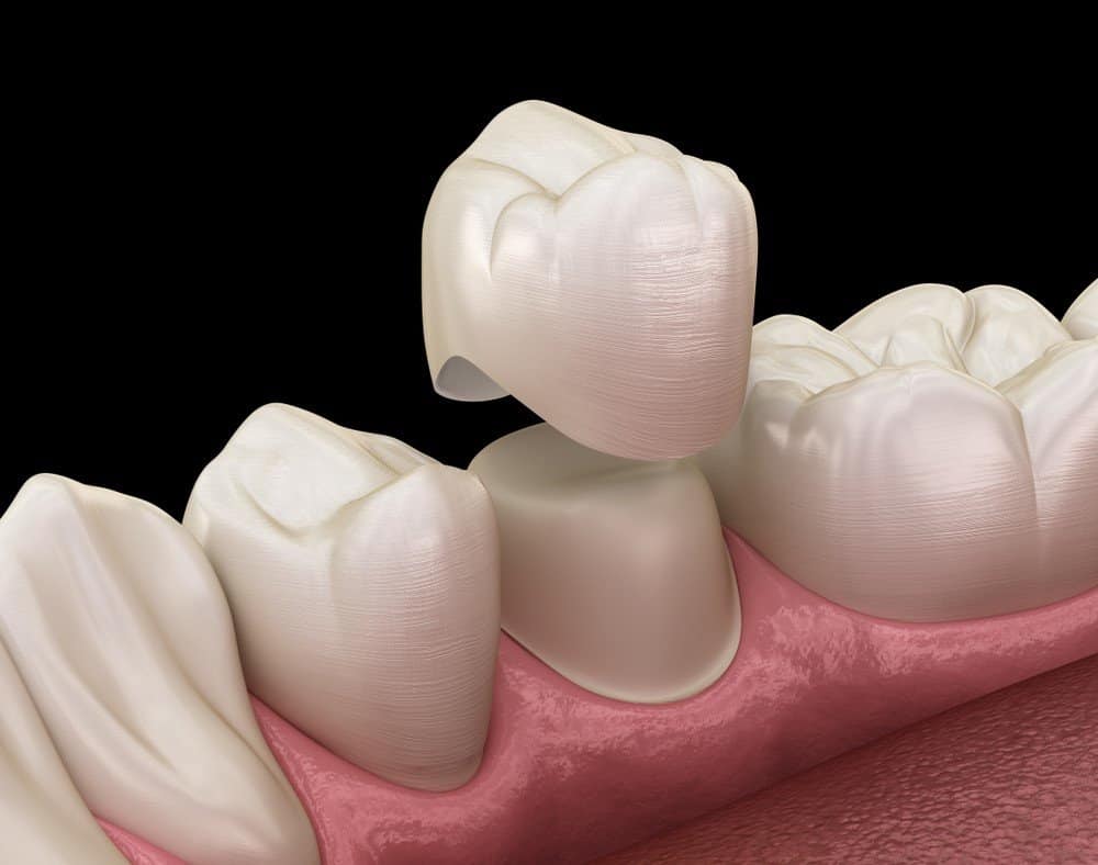 Teeth Whitening: Separating Facts from Fiction Southall